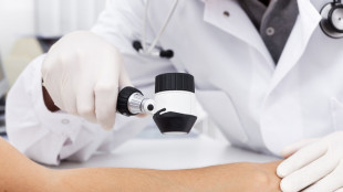 Melanoma, l'immunoterapia 'dual block' diventa standard